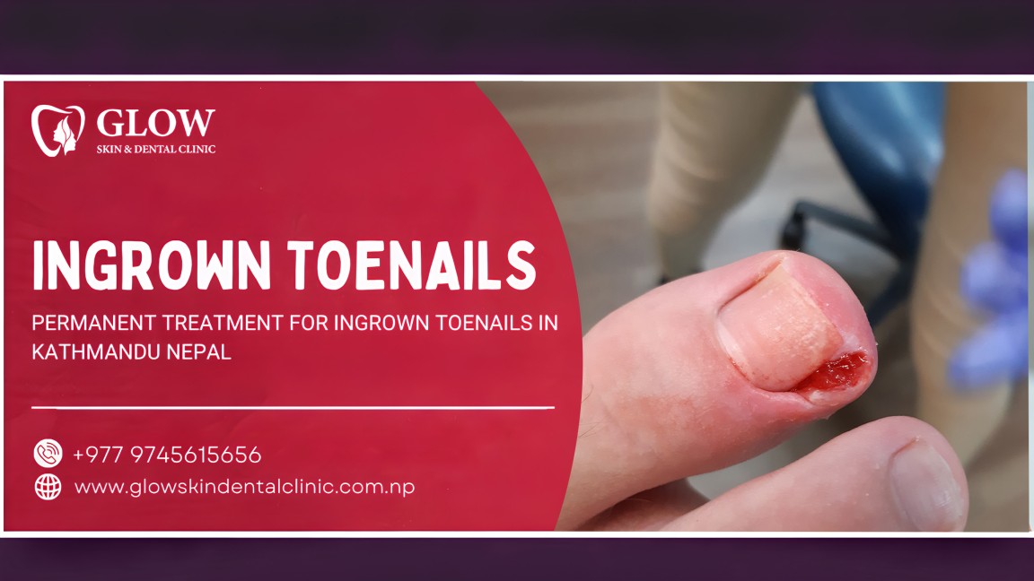 INGROWN TOENAILS
