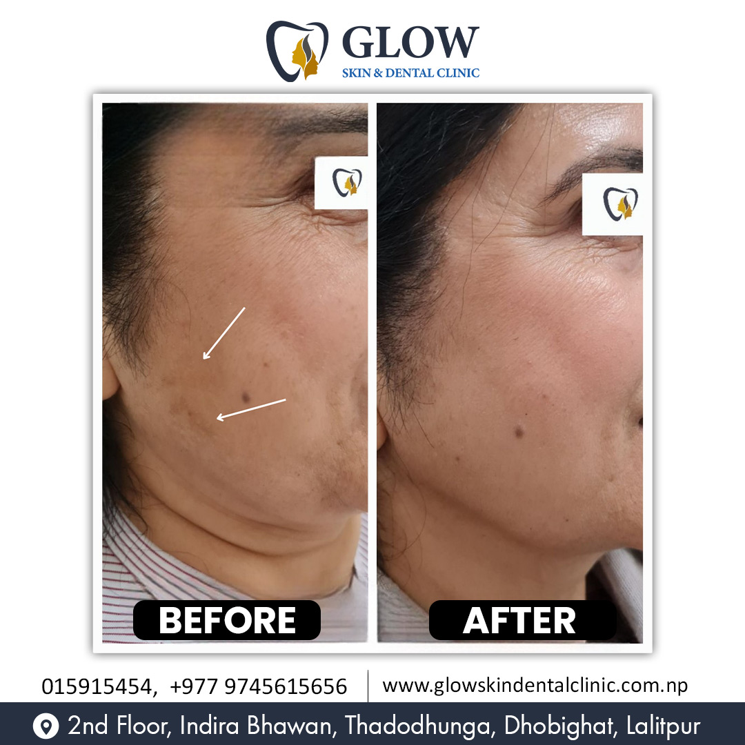 Melasma & Hyperpigmentation 