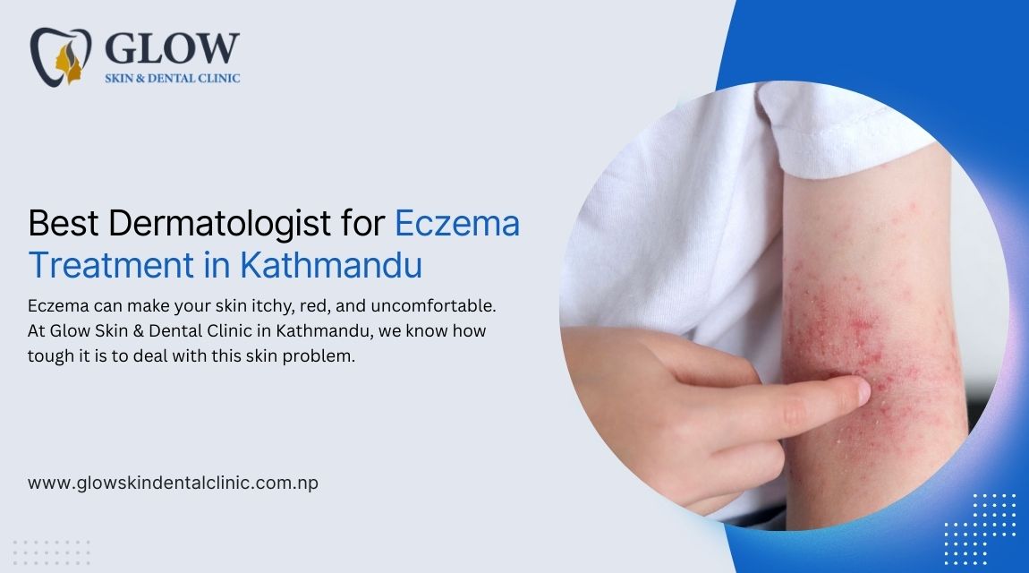 Best Dermatologist for Eczema Treatment in Kathmandu