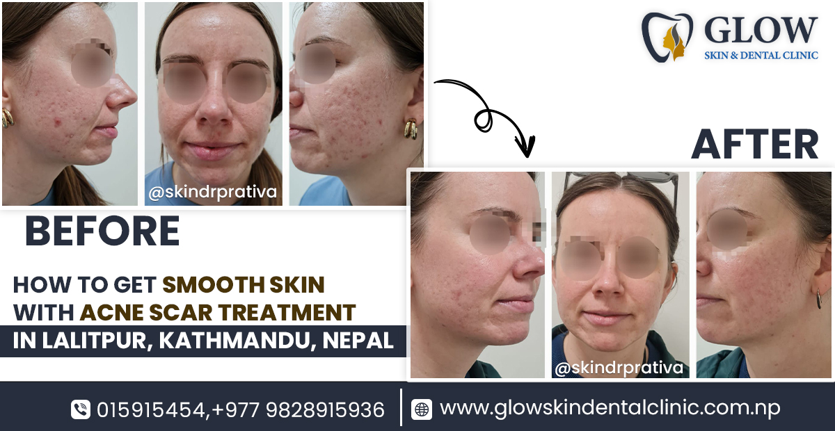 Acne Scar Treatment in Lalitpur, Kathmandu