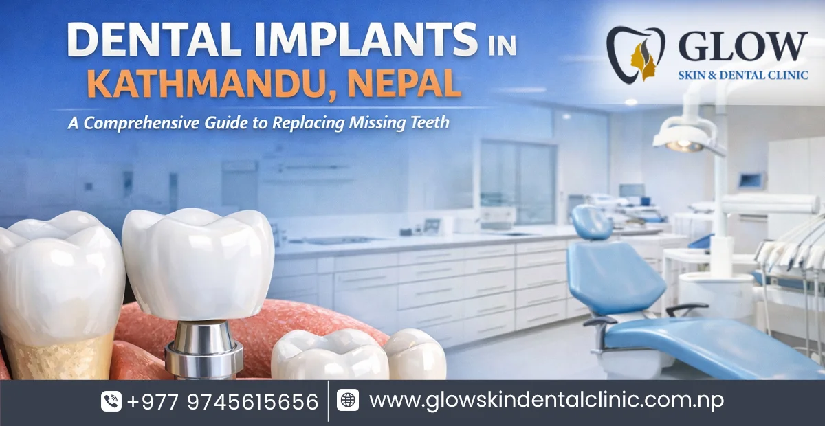 Dental Implants in Kathmandu, Nepal: A Comprehensive Guide to Replacing Missing Teeth